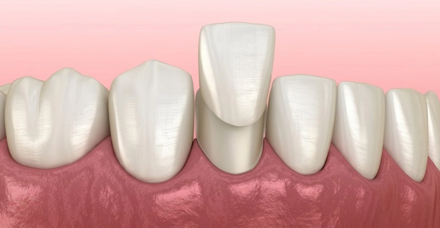 Veneers in Turkey1